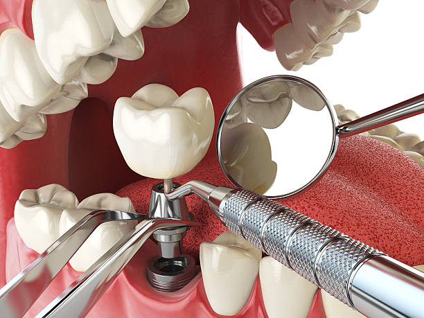 Best Emergency Wisdom Teeth Removal in Montvale, NJ